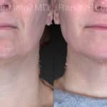 Chin Filler Before and After Photos in Newburgh, NY, Patient 21103