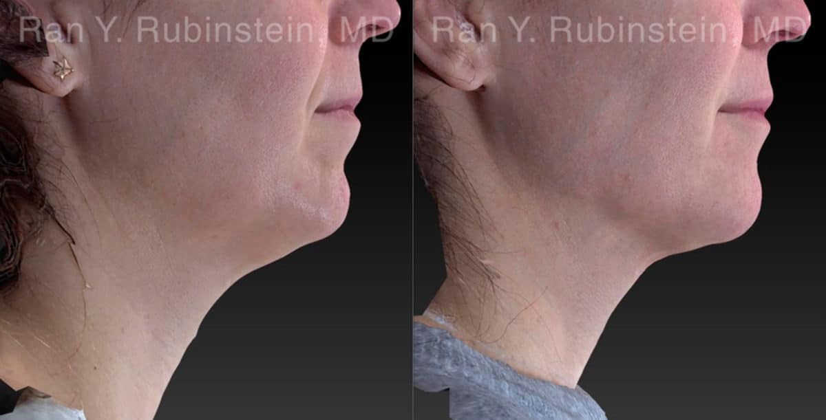 Chin Filler Before and After Photos in Newburgh, NY, Patient 21103