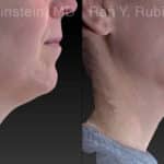 Chin Filler Before and After Photos in Newburgh, NY, Patient 21103