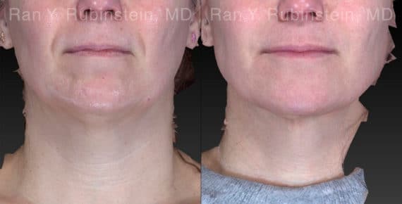 Chin Filler Before and After Photos in Newburgh, NY, Patient 21103