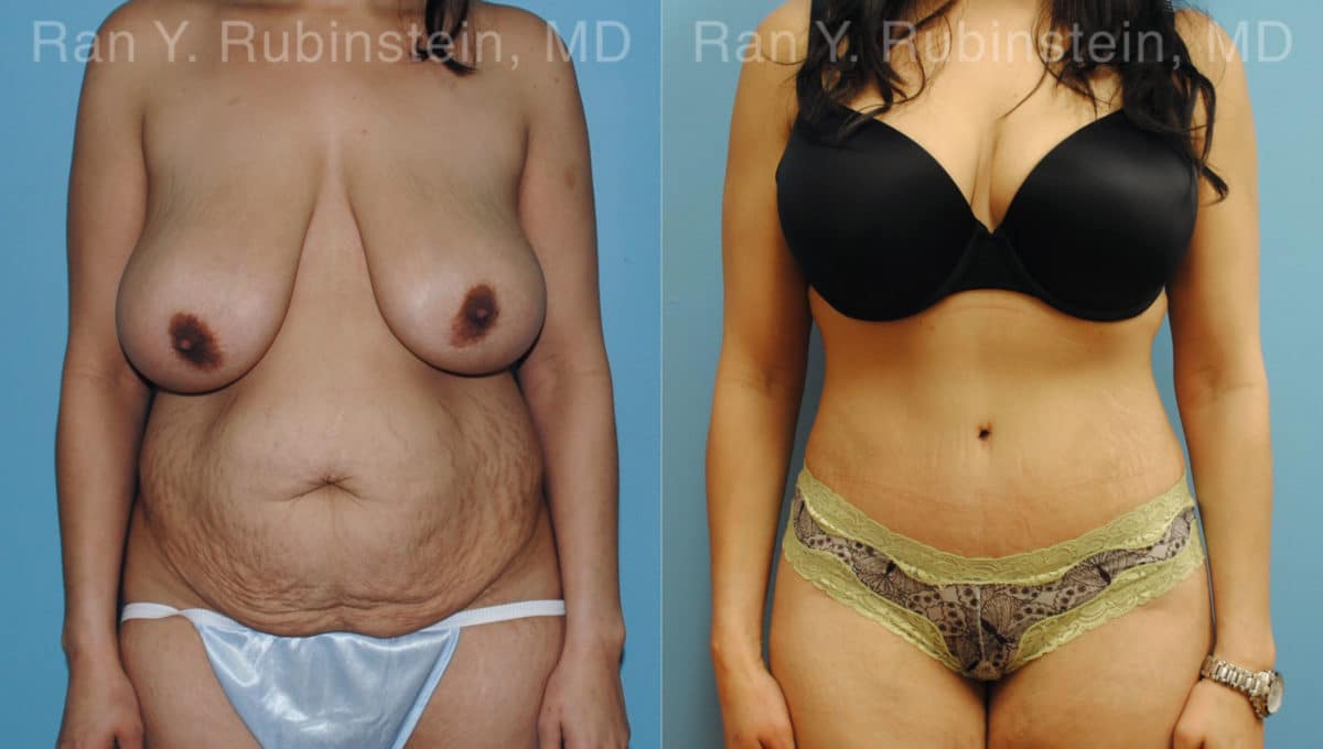 Abdominoplasty Before and After Photos in Newburgh, NY, Patient 12236