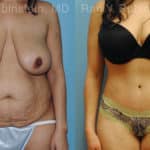 Abdominoplasty Before and After Photos in Newburgh, NY, Patient 12236