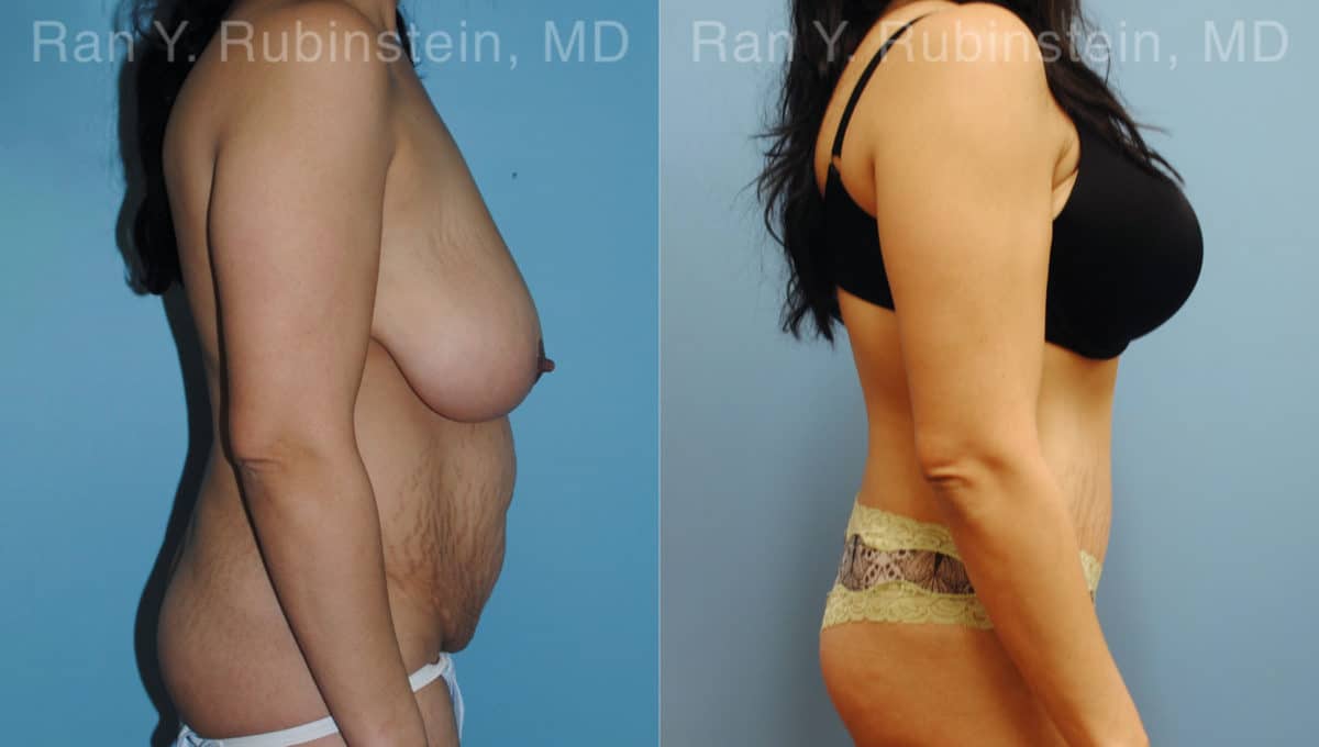 Abdominoplasty Before and After Photos in Newburgh, NY, Patient 12236