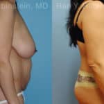 Abdominoplasty Before and After Photos in Newburgh, NY, Patient 12236