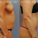 Abdominoplasty Before and After Photos in Newburgh, NY, Patient 12246