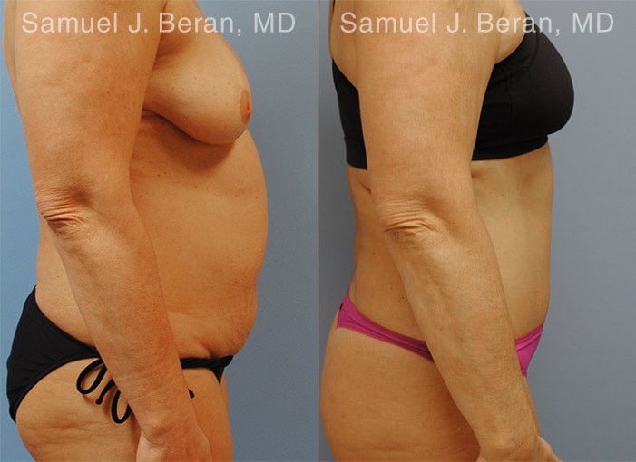 Abdominoplasty Before and After Photos in Newburgh, NY, Patient 12246