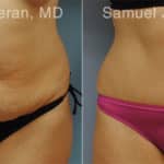 Abdominoplasty Before and After Photos in Newburgh, NY, Patient 12246