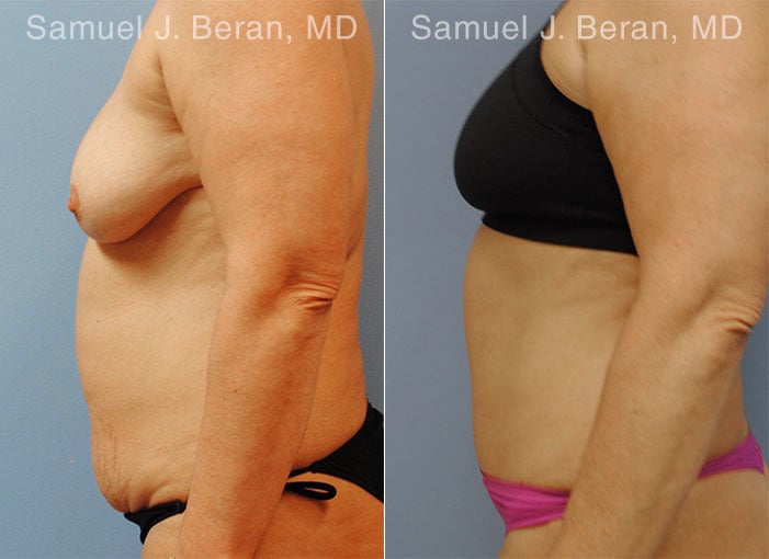 Abdominoplasty Before and After Photos in Newburgh, NY, Patient 12246