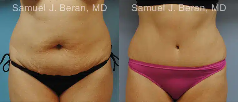 Abdominoplasty Before and After Photos in Newburgh, NY, Patient 12246