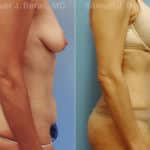 Abdominoplasty Before and After Photos in Newburgh, NY, Patient 12253