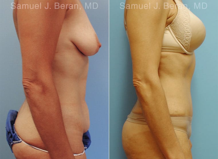 Abdominoplasty Before and After Photos in Newburgh, NY, Patient 12253