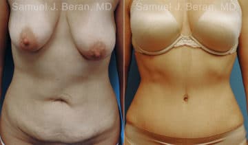 Abdominoplasty Before and After Photos in Newburgh, NY, Patient 12253