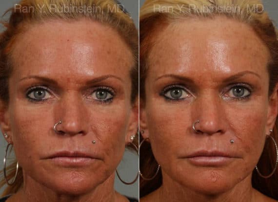 Botox Before and After Photos in Newburgh, NY, Patient 12271