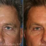 Botox Before and After Photos in Newburgh, NY, Patient 12276