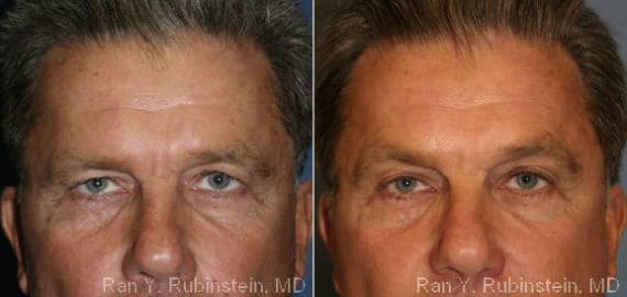 Botox Before and After Photos in Newburgh, NY, Patient 12276