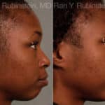 Chin Augmentation Before and After Photos in Newburgh, NY, Patient 12384