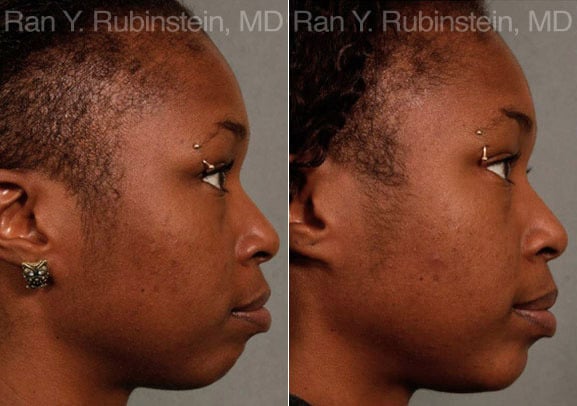 Chin Augmentation Before and After Photos in Newburgh, NY, Patient 12384