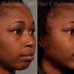 Chin Augmentation Before and After Photos in Newburgh, NY, Patient 12384