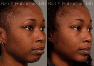 Chin Augmentation Before and After Photos in Newburgh, NY, Patient 12384