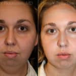 Chin Augmentation Before and After Photos in Newburgh, NY, Patient 12389