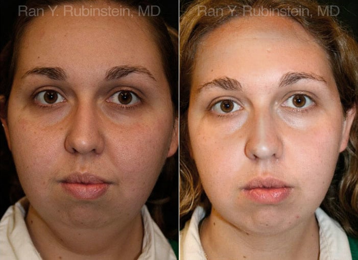 Chin Augmentation Before and After Photos in Newburgh, NY, Patient 12389