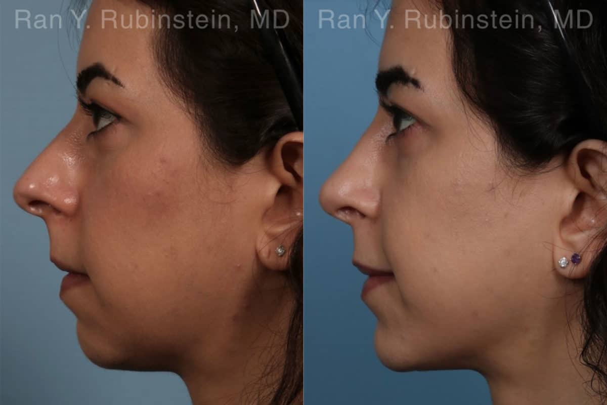 Chin Augmentation Before and After Photos in Newburgh, NY, Patient 12394