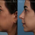 Chin Augmentation Before and After Photos in Newburgh, NY, Patient 12394