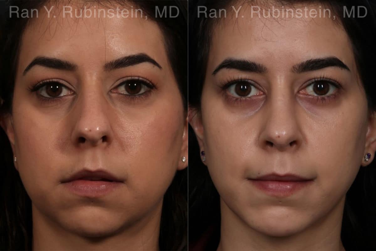 Chin Augmentation Before and After Photos in Newburgh, NY, Patient 12394