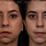 Chin Augmentation Before and After Photos in Newburgh, NY, Patient 12394