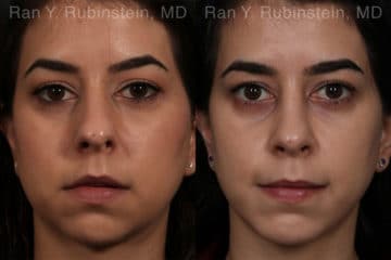 Chin Augmentation Before and After Photos in Newburgh, NY, Patient 12394