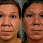 Chin Augmentation Before and After Photos in Newburgh, NY, Patient 12404