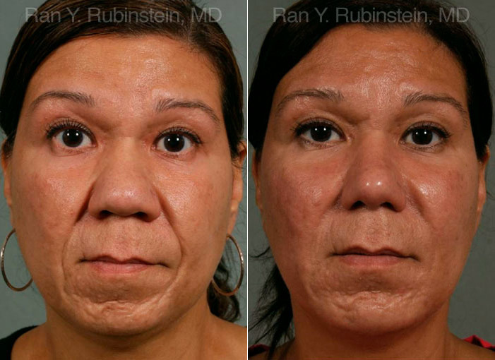 Chin Augmentation Before and After Photos in Newburgh, NY, Patient 12404