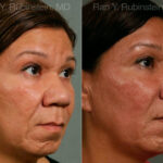 Chin Augmentation Before and After Photos in Newburgh, NY, Patient 12404