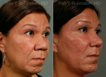 Chin Augmentation Before and After Photos in Newburgh, NY, Patient 12404