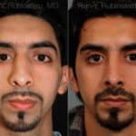 Ethnic Rhinoplasty Before and After Photos in Newburgh, NY, Patient 12558