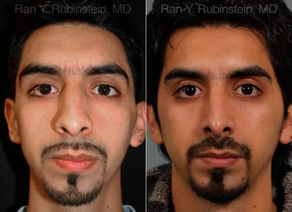 Ethnic Rhinoplasty Before and After Photos in Newburgh, NY, Patient 12558