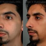 Ethnic Rhinoplasty Before and After Photos in Newburgh, NY, Patient 12558