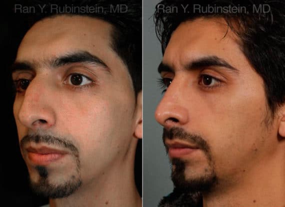 Ethnic Rhinoplasty Before and After Photos in Newburgh, NY, Patient 12558