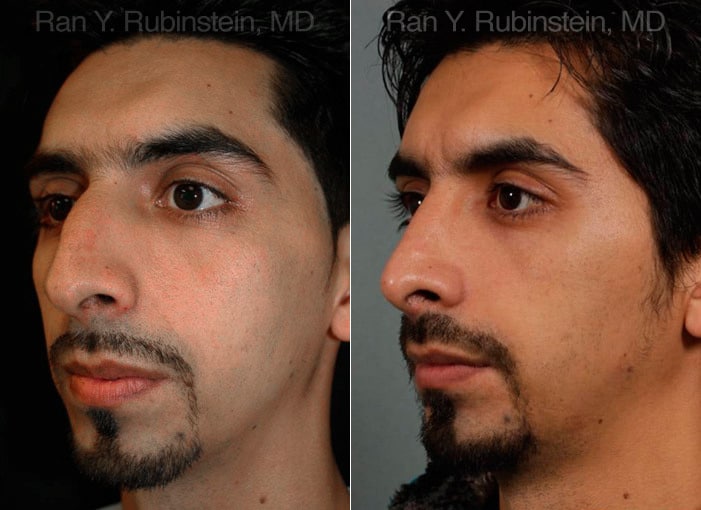 Ethnic Rhinoplasty Before and After Photos in Newburgh, NY, Patient 12558