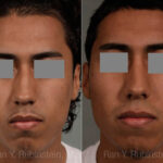 Ethnic Rhinoplasty Before and After Photos in Newburgh, NY, Patient 12578