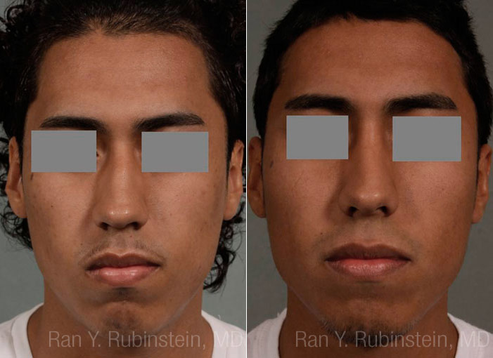 Ethnic Rhinoplasty Before and After Photos in Newburgh, NY, Patient 12578