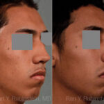 Ethnic Rhinoplasty Before and After Photos in Newburgh, NY, Patient 12578