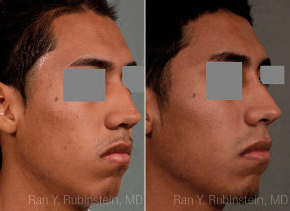 Ethnic Rhinoplasty Before and After Photos in Newburgh, NY, Patient 12578