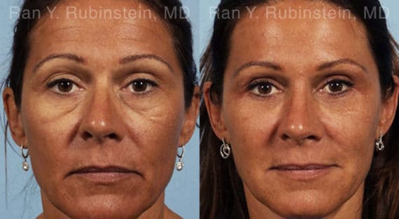 Eyelid Surgery Before and After Photos in Newburgh, NY, Patient 12586