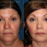 Face lift & Neck lift Before and After Photos in Newburgh, NY, Patient 12629