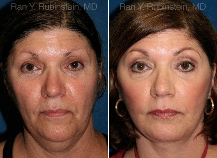 Face lift & Neck lift Before and After Photos in Newburgh, NY, Patient 12629