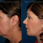 Face lift & Neck lift Before and After Photos in Newburgh, NY, Patient 12629