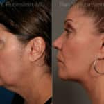 Face lift & Neck lift Before and After Photos in Newburgh, NY, Patient 12629