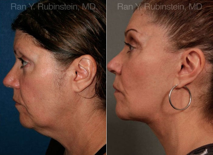 Face lift & Neck lift Before and After Photos in Newburgh, NY, Patient 12629