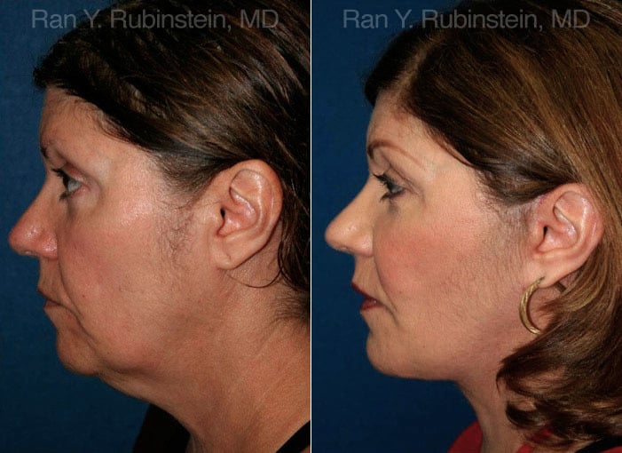 Face lift & Neck lift Before and After Photos in Newburgh, NY, Patient 12629